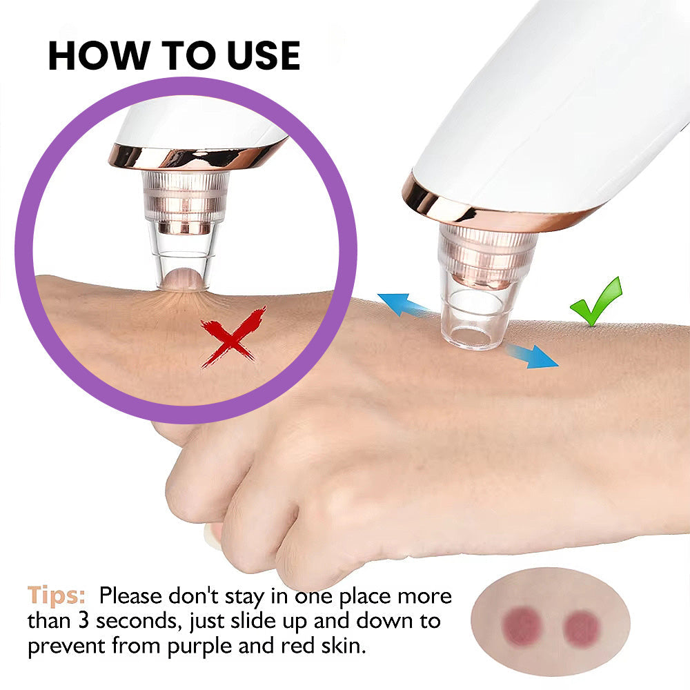 Vacuum Pore Cleaner - Remove Blackheads Without Irritation or Redness